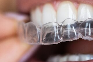 Transparente Zahn- und Aufbissschiene im Mund. @ 